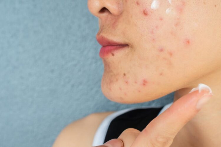 Cauzele apariției acneii fungice. Simptome și tratament
