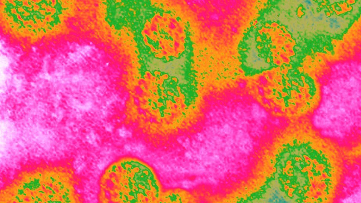 Cancerul de colon a devenit principala cauză de deces prin cancer la persoanele sub 50 de ani